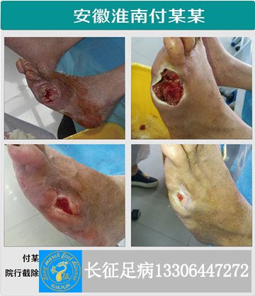 1515741429972612.jpg 小脚趾截肢_副本.jpg