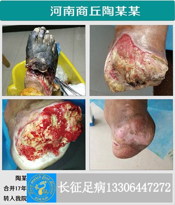 1516695698706024.jpg 5级干性坏疽_副本.jpg