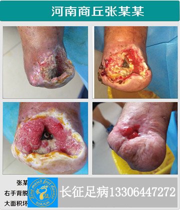 1520824704284624.jpg 术后创面不愈副本.jpg