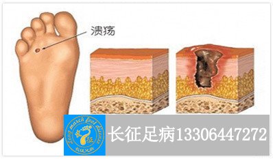 1521534486246135.jpg 烂脚.jpg