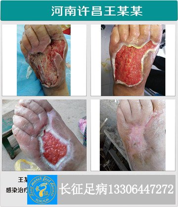 1521081706313203.jpg 溃疡<a  data-cke-saved-href='http://www.haodf.com/jibing/ganran.htm' href='http://www.haodf.com/jibing/ganran.htm' style='text-decoration:none;' target='_blank'>感染</a>_副本.jpg