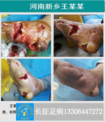 1522571952232133.jpg 感染_副本.jpg