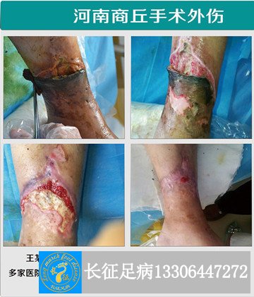 1523261615345026.jpg 外伤难愈合_副本.jpg