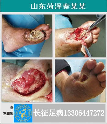 1523610002286062.jpg 四次截趾后不愈合.jpg