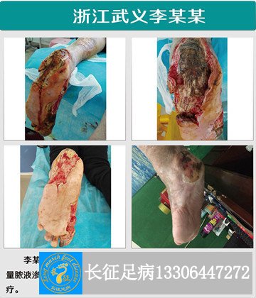 1525853255544402.jpg 化脓严重副本.jpg