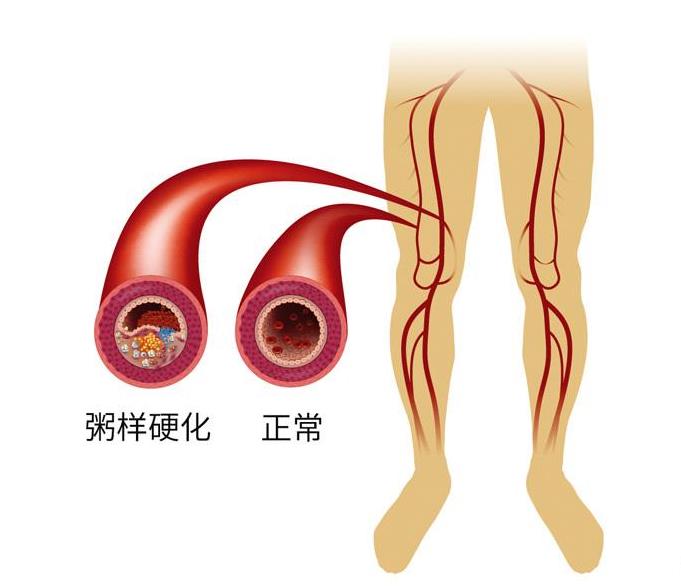 袁敏琴：糖尿病患者合并下肢动脉闭塞症很严重要尽快治疗！