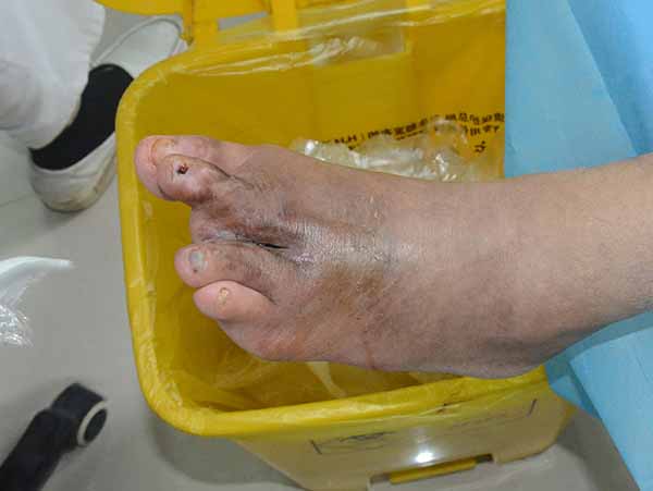 康复案例：云南糖尿病足患者脚趾扩创截趾后伤口感染不愈合的保守治疗