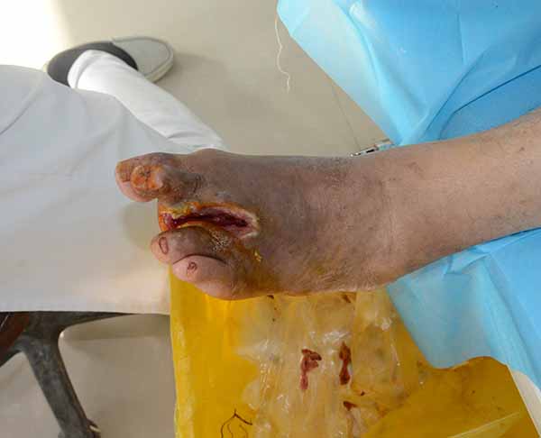 康复案例：云南糖尿病足患者脚趾扩创截趾后伤口感染不愈合的保守治疗