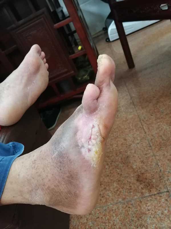 案例:糖尿病足截趾后电烤伤口结痂严重,中西医结合开放式保守治疗