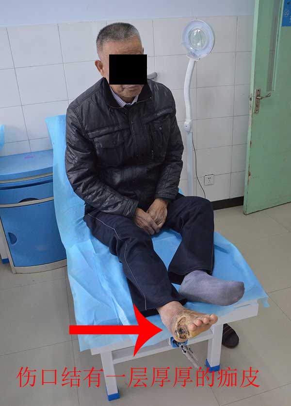 案例:糖尿病足截趾后电烤伤口结痂严重,中西医结合开放式保守治疗