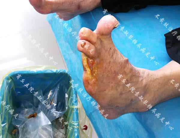 康复案例：糖尿病烂脚脚趾截除缝合伤口又感染能保守治吗