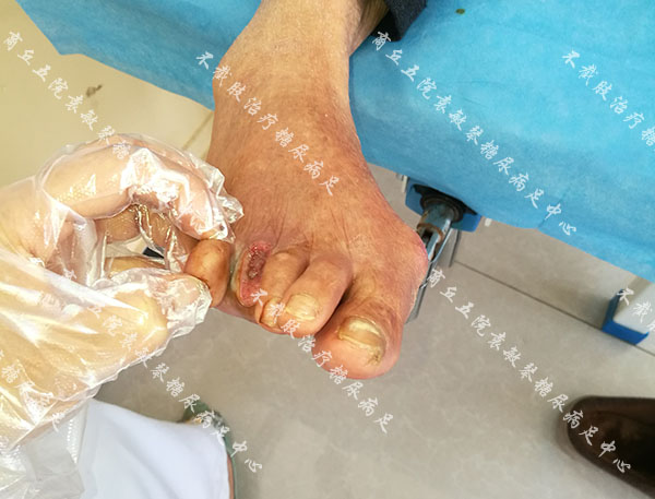 糖尿病足下肢血管闭塞,做支架疏通无效面临截肢