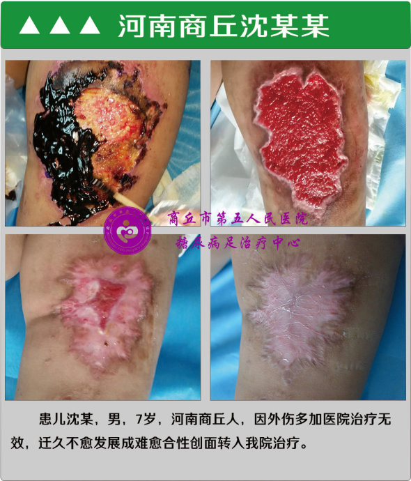 长征足病网
