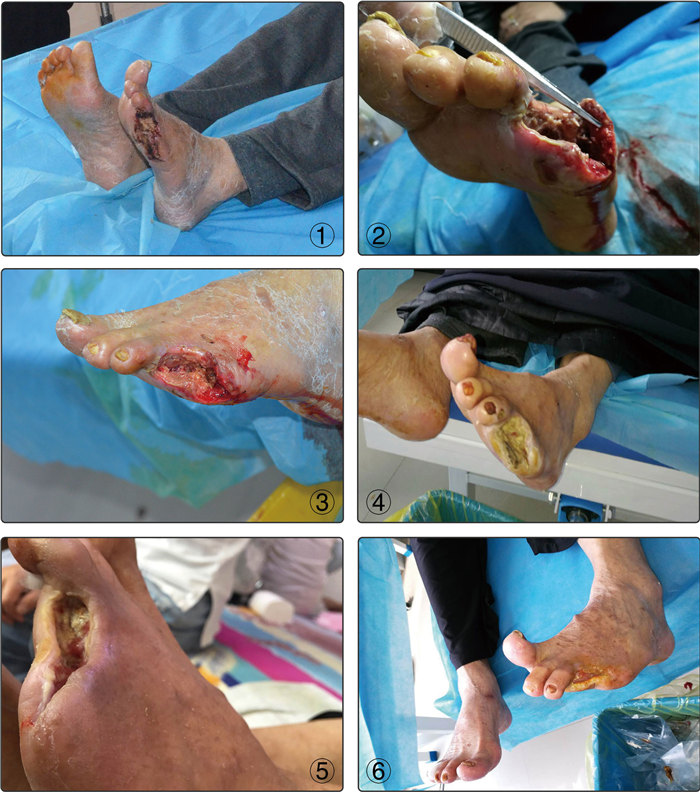 糖尿病足康复病例
