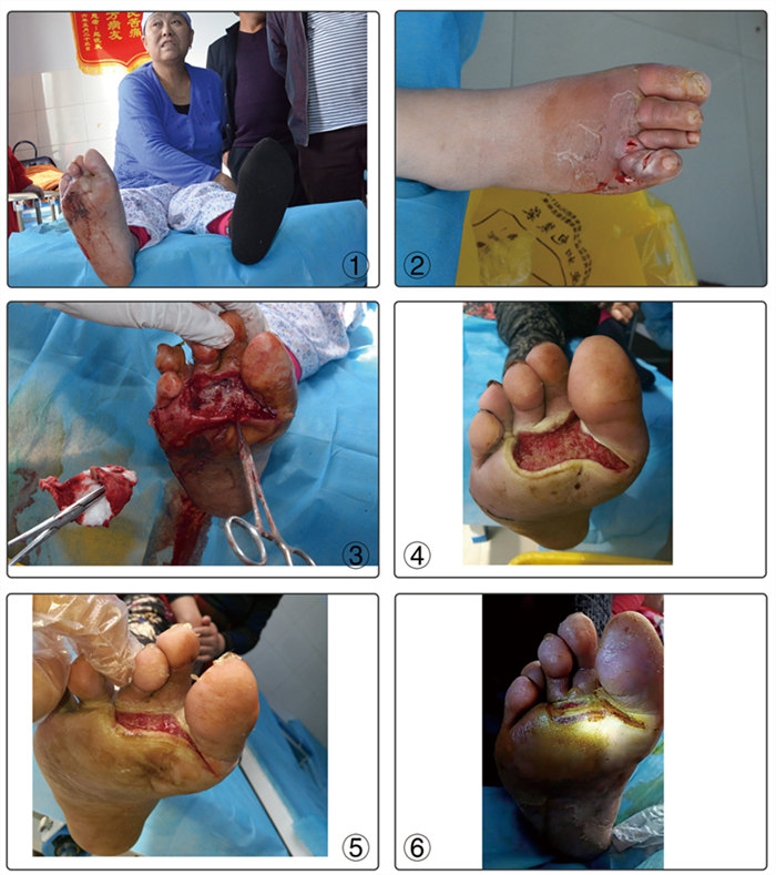 糖尿病足康复病例