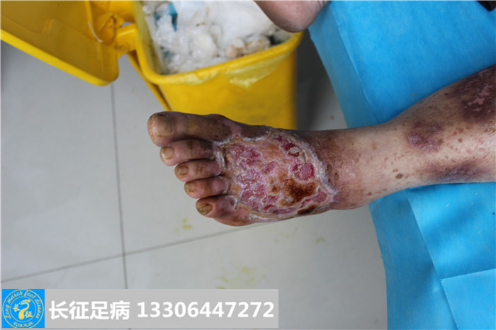 糖尿病足怎么治疗