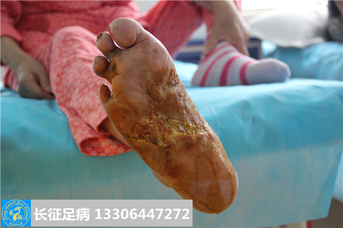 糖尿病足怎么治疗