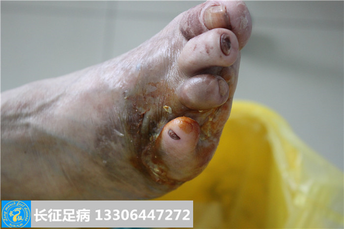 糖尿病足怎么治疗