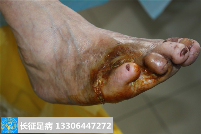 糖尿病足怎么治疗