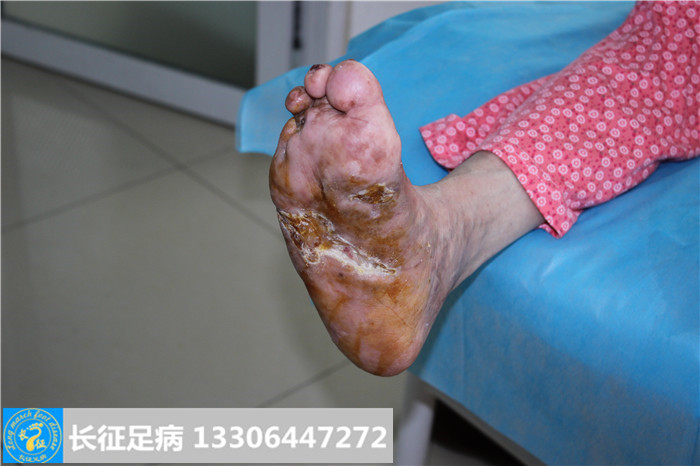 糖尿病足怎么治疗