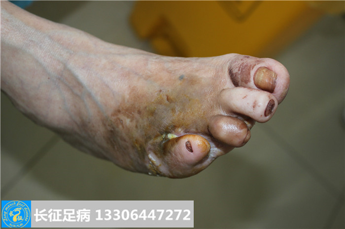 糖尿病足怎么治疗