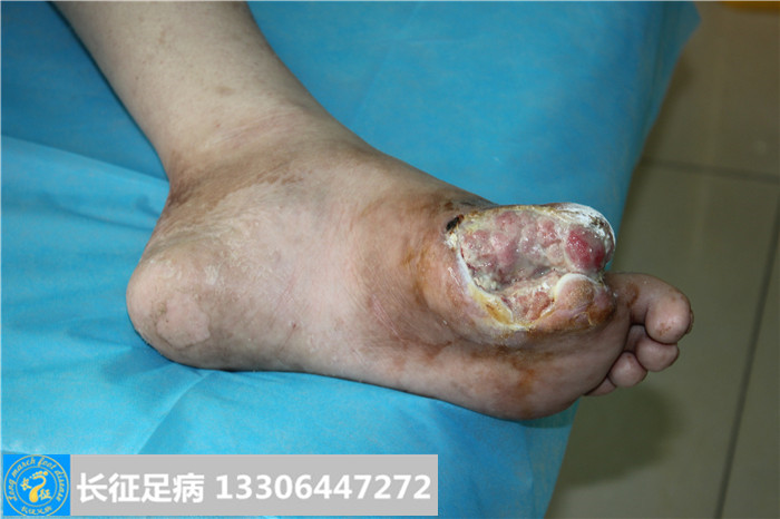 糖尿病足怎么治疗