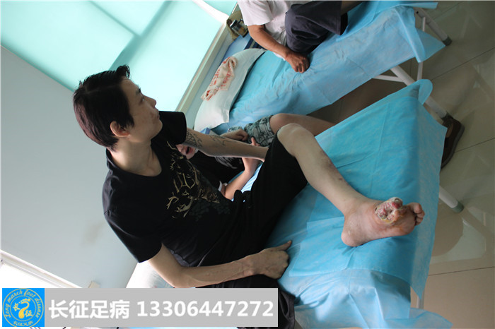 糖尿病足怎么治疗