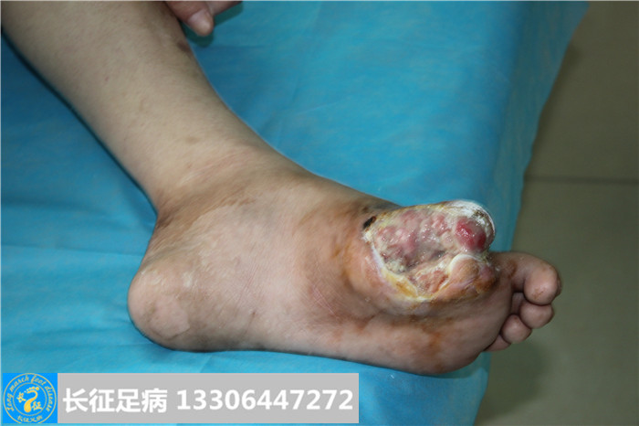 糖尿病足怎么治疗
