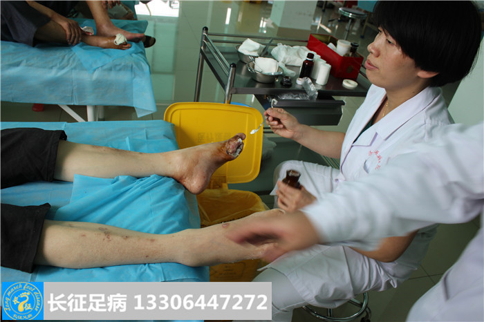 糖尿病足怎么治疗