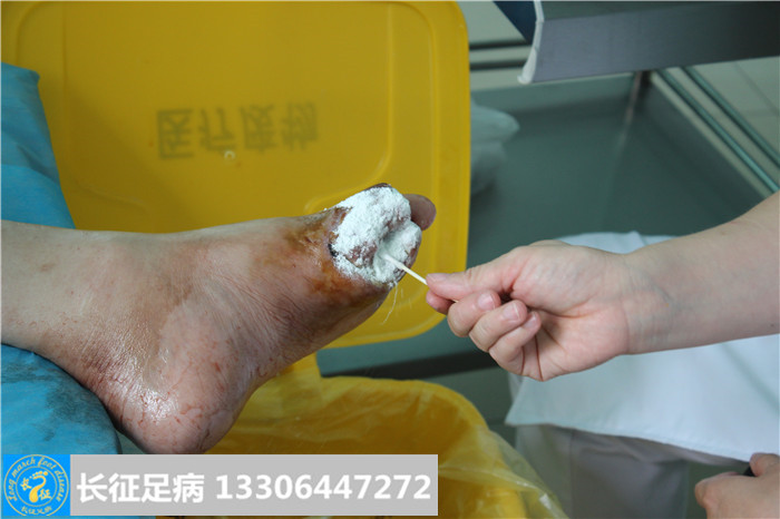 糖尿病足怎么治疗