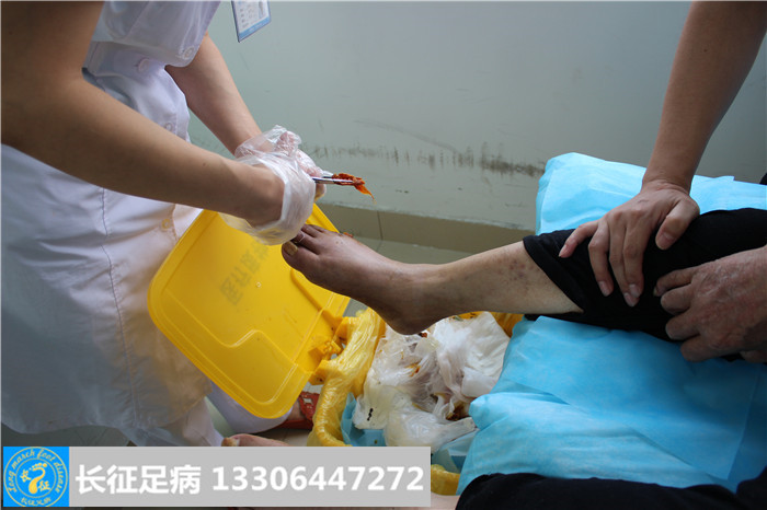 糖尿病足坏疽