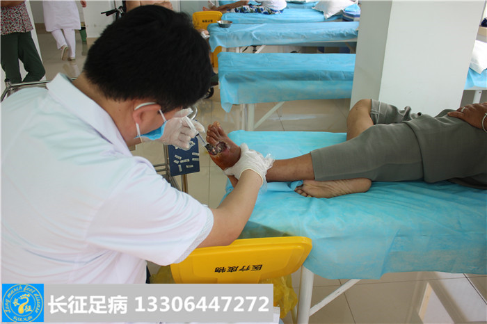 糖尿病足坏疽