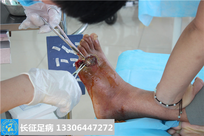 糖尿病足坏疽