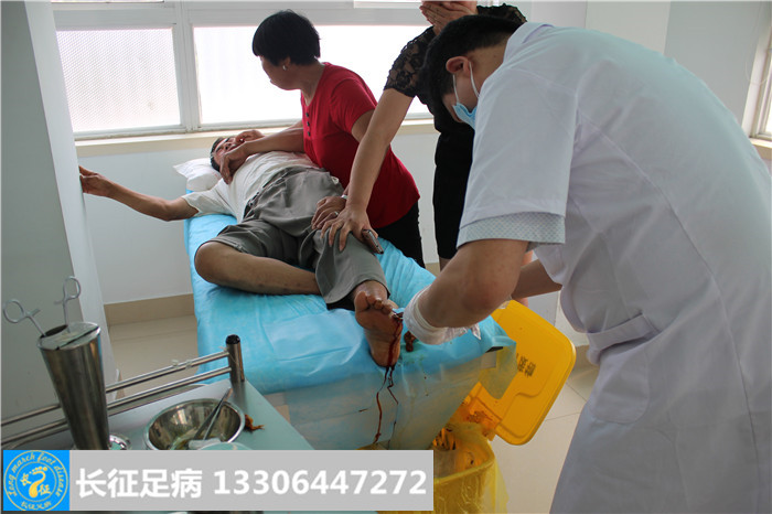 糖尿病足坏疽