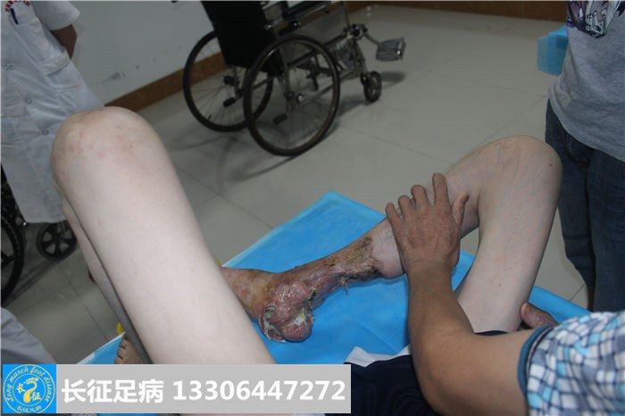 糖尿病足坏疽
