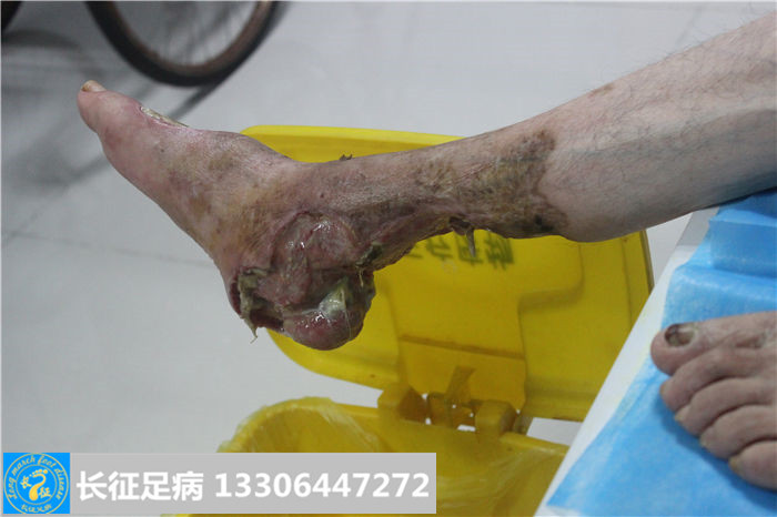 糖尿病足坏疽