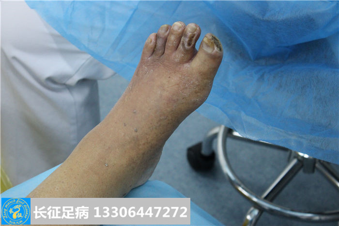糖尿病足溃烂