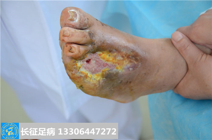 糖尿病足溃烂