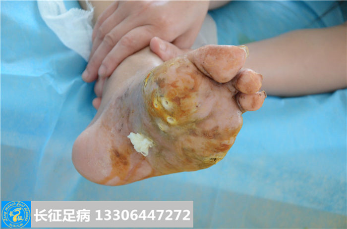 糖尿病足溃烂