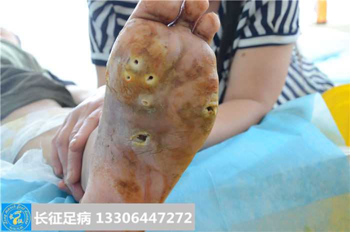 糖尿病足溃烂
