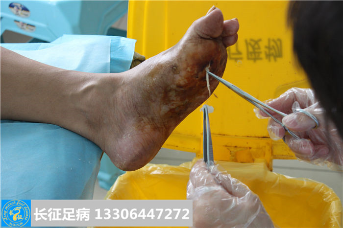 糖尿病足溃烂