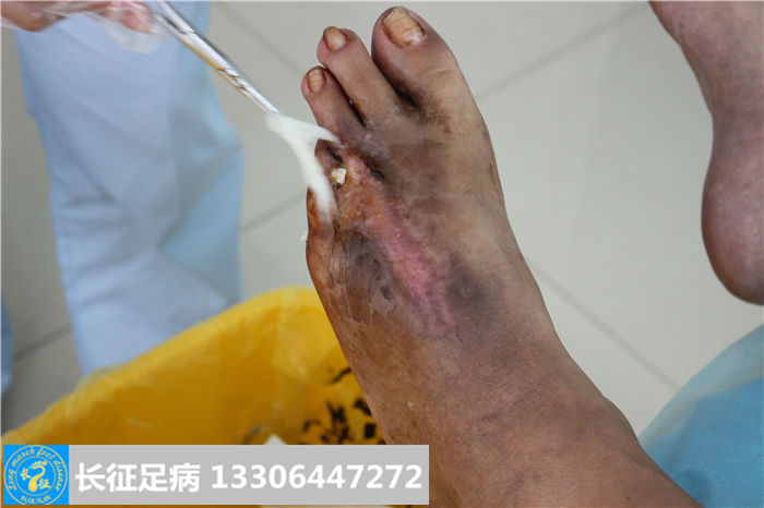 糖尿病足溃烂