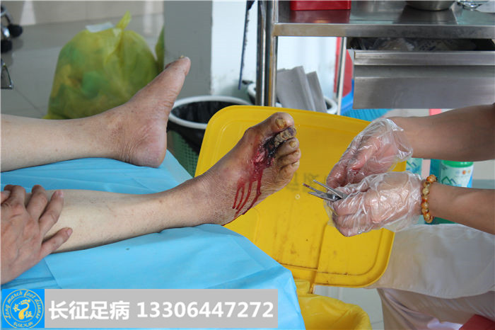 糖尿病足溃烂