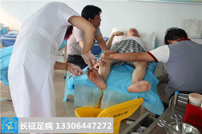 糖尿病足溃烂