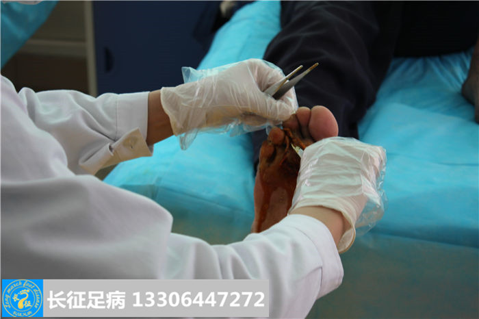 糖尿病足溃烂