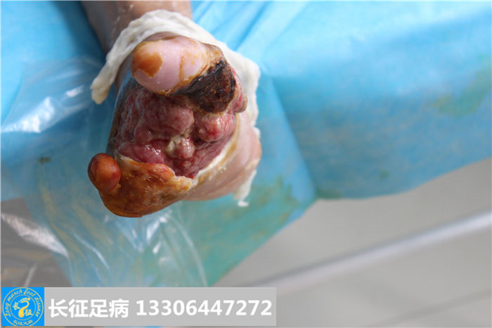 糖尿病足截肢