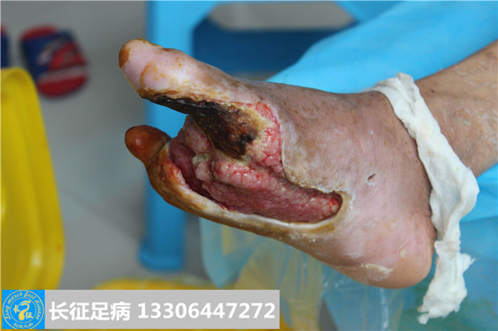 糖尿病足截肢