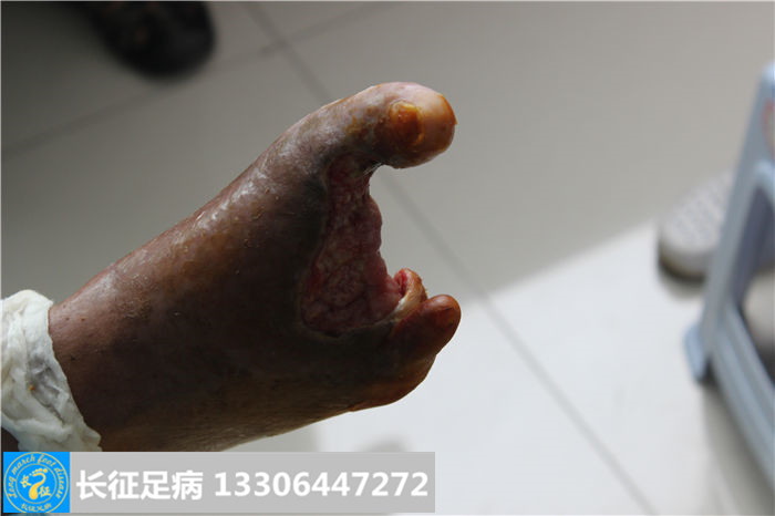 糖尿病足截肢