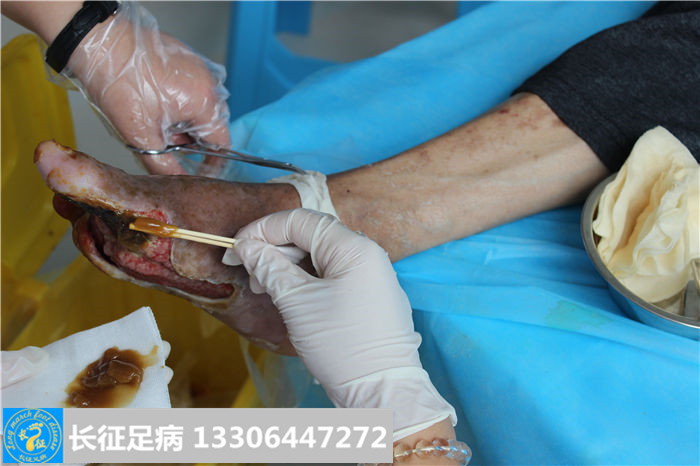 糖尿病足截肢