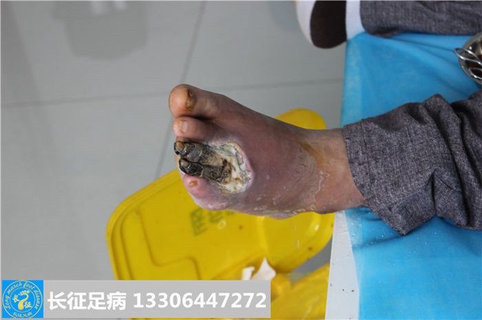 糖尿病足截肢